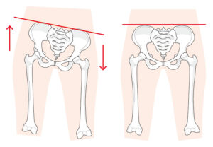 骨盤の歪み