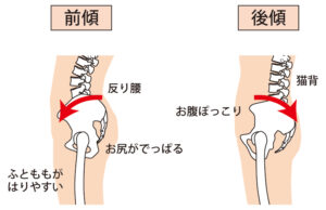 骨盤の前傾・後傾と腰椎カーブの図解